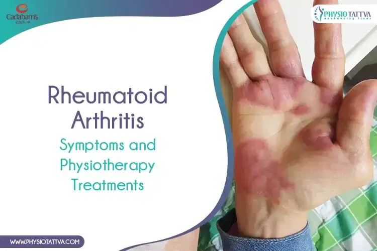 Rheumatoid Arthritis : Symptoms and Physiotherapy Treatments