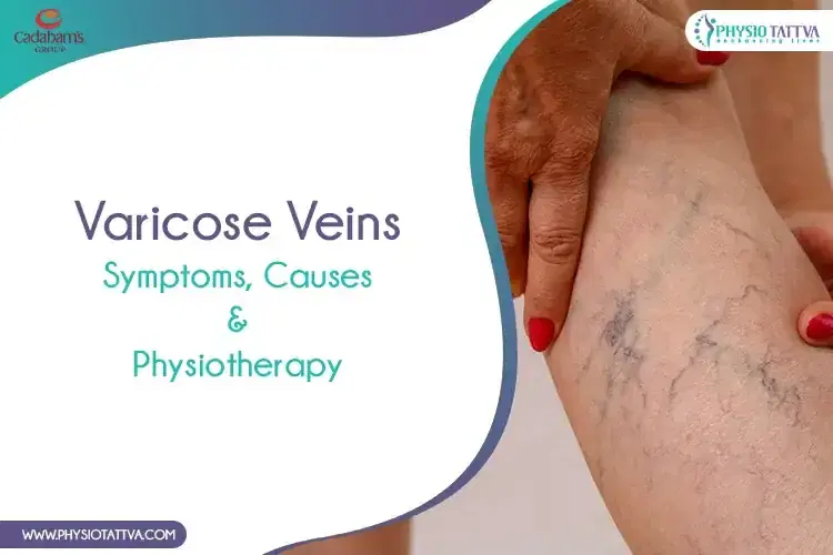 Symptoms, Causes & Physiotherapy for Varicose Veins