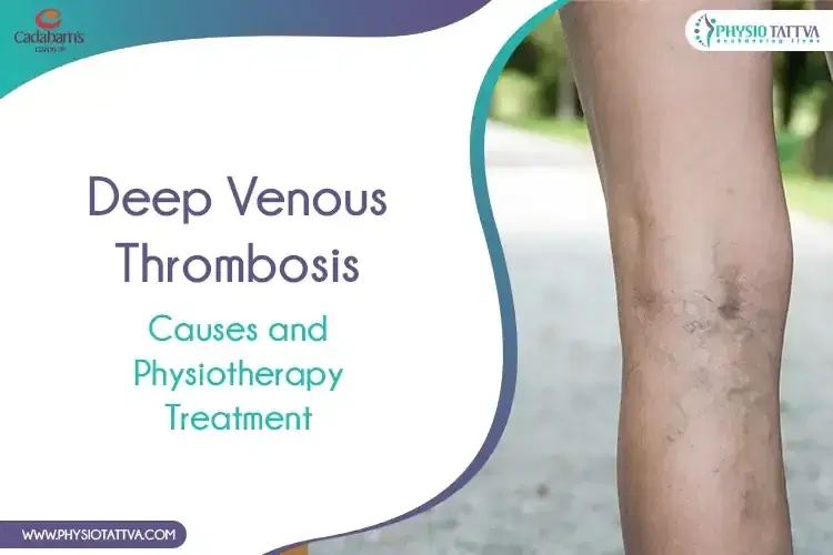 Deep Venous Thrombosis | Causes and Physiotherapy Treatment