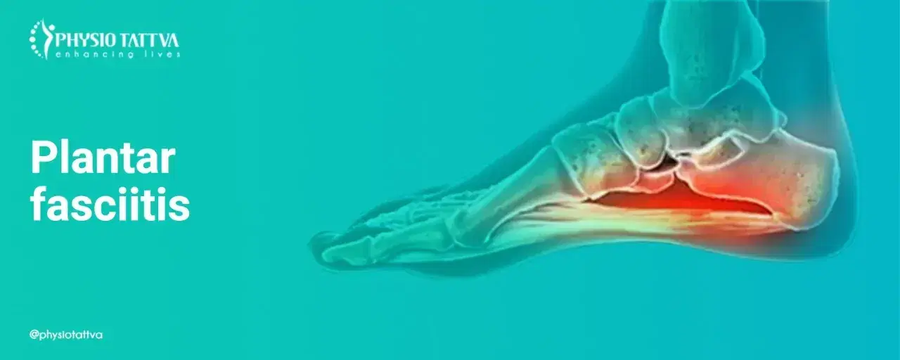 Plantar Fasciitis