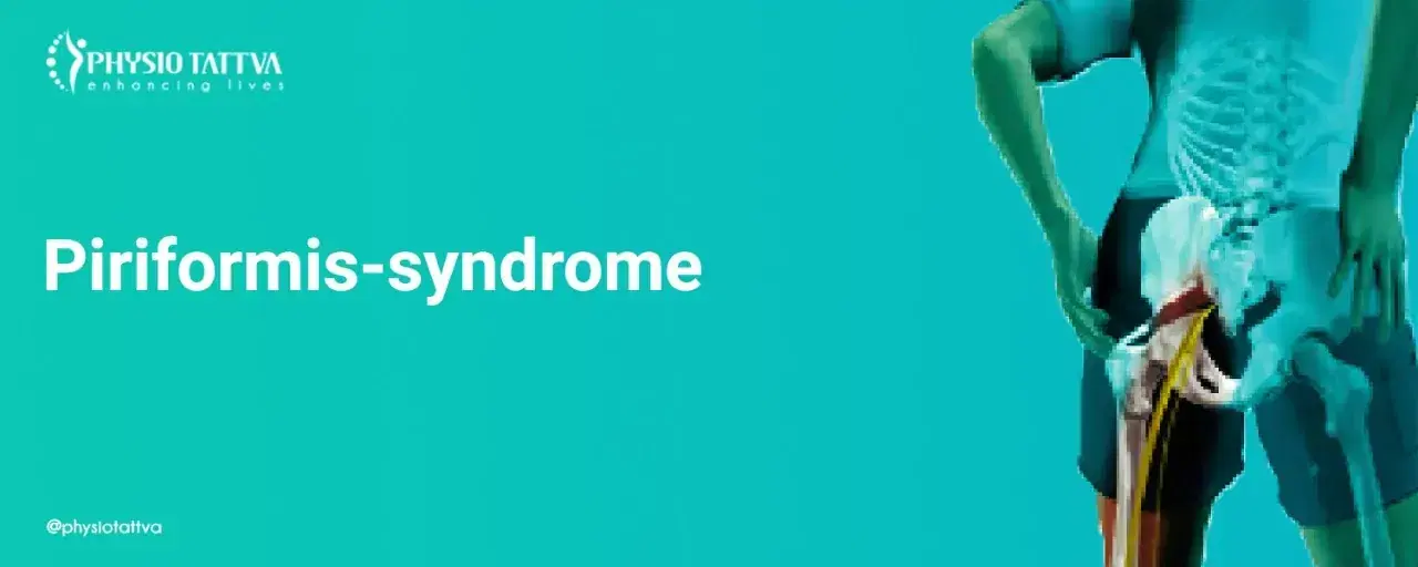 Piriformis Syndrome
