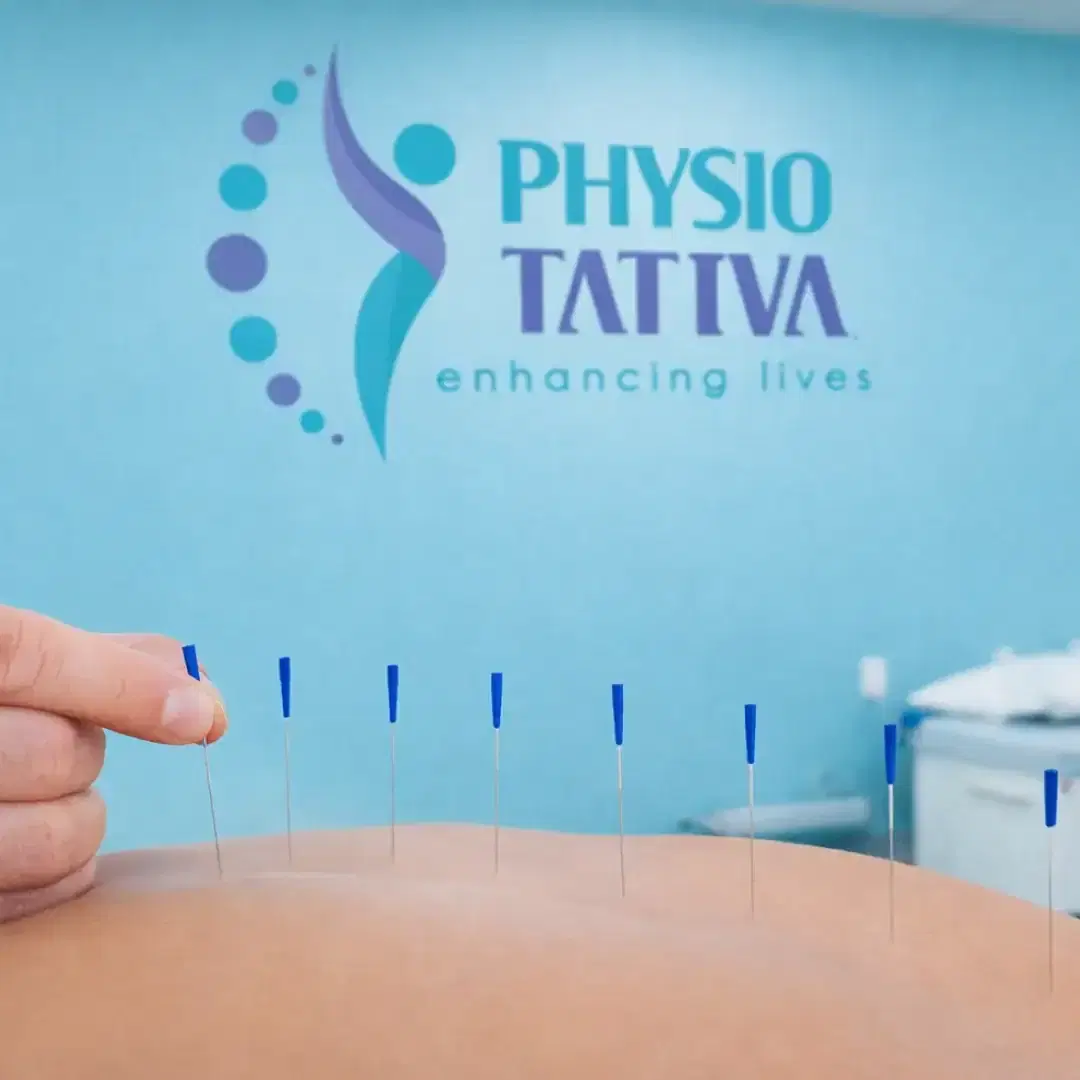 Dry Needling Therapy