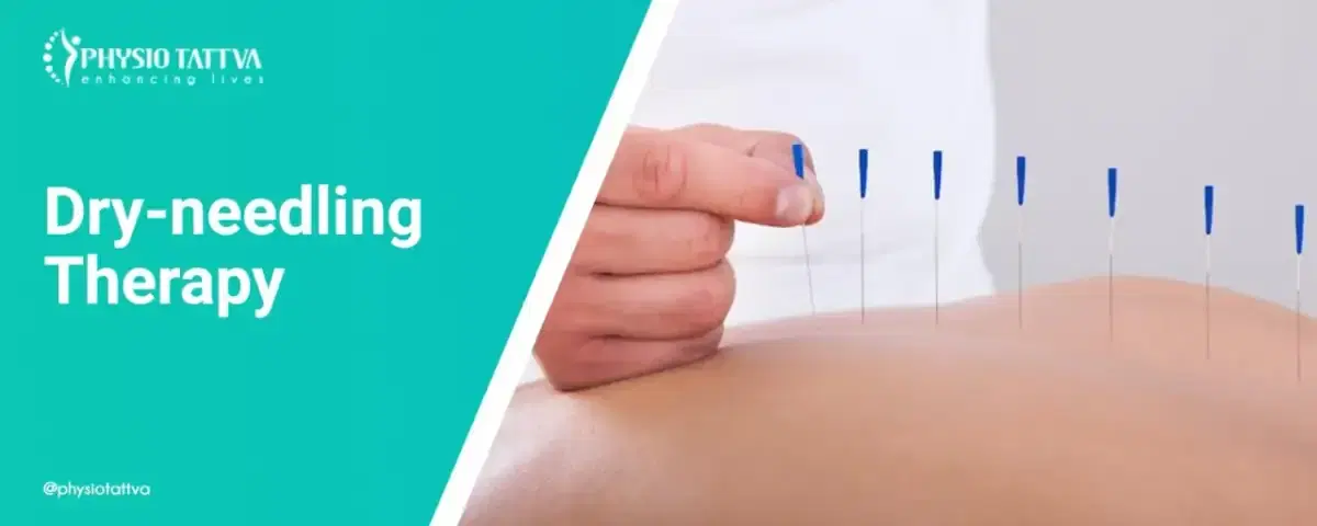 Dry Needling Therapy
