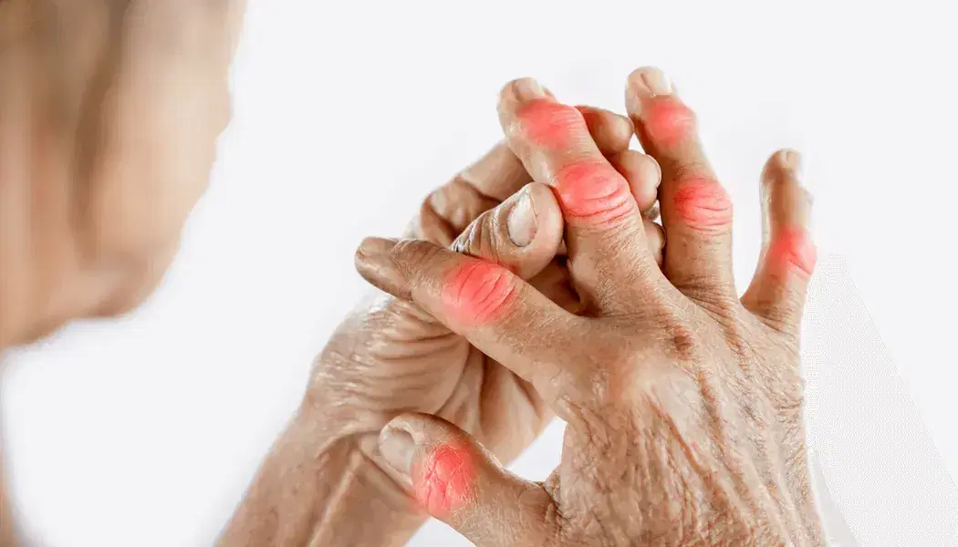 Physiotherapy Treatment for Inflammation